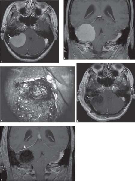 18 Tentorial Meningiomas Neupsy Key