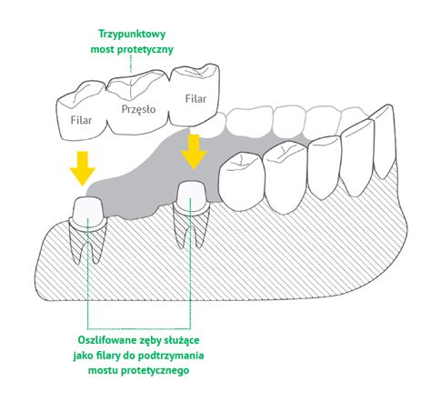 Co Ka Dy Powinien Wiedzie O Koronach I Mostach Z B W Dentim Clinic