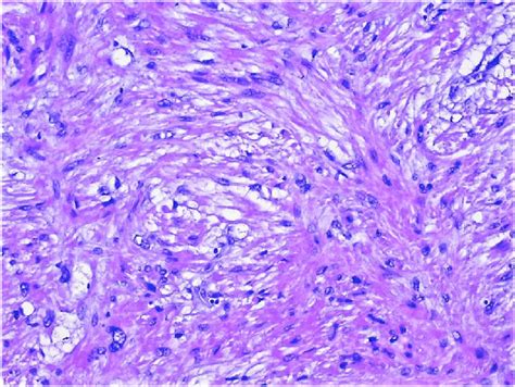 The Tumor Is Composed Of Cellular Bundles Of Atypical Spindle Cells