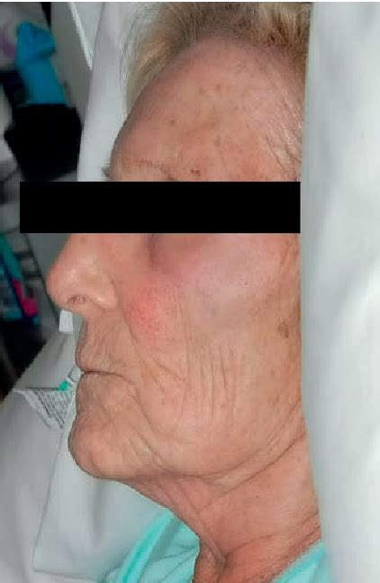 Figure 1 From A Case Report Of Dermatomyositis Associated With Small