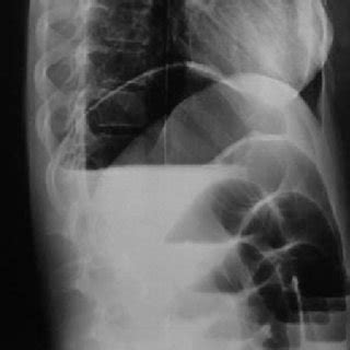 Plain Abdominal X Ray Demonstrated Air Fluid Levels Of The Small Bowel