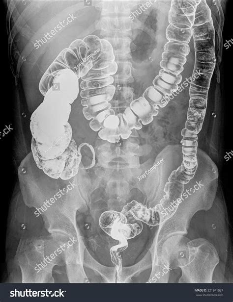 X Ray Colon Bariumap View Pre Stock Photo 221841037 Shutterstock