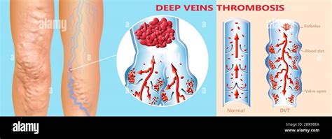 Deep Vein Thrombosis Or Blood Clots Embolus Structure Of Normal And