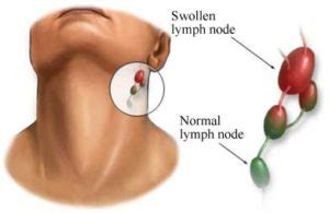 Painful lymph nodes - ludacanvas