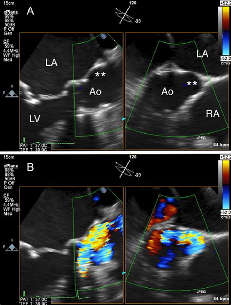 A Transesophageal Echocardiography Tee Revealed A Saccular Download Scientific Diagram