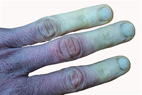 Scoperte Le Basi Genetiche Della Sindrome Di Raynaud