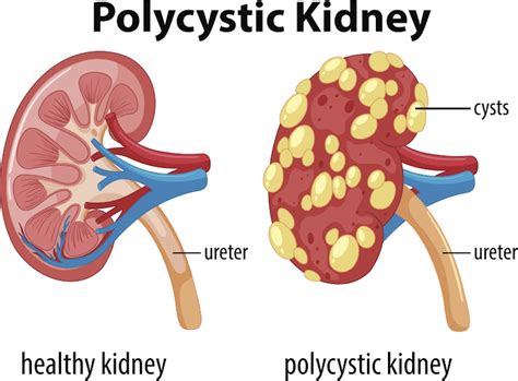 The Kidney Disease Thats Going Unnoticed The New Daily