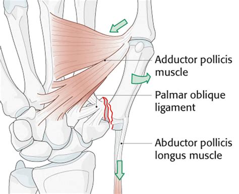 Rolando Fracture Causes Symptoms Diagnosis Treatment Recovery