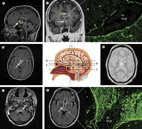 The Spectrum Of Neuromyelitis Optica The Lancet Neurology