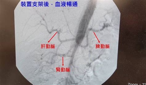 43歲新竹男劇烈肚子痛，竟然是主動脈剝離！醫師提醒：想預防做好「3件事」｜心臟血管｜醫療｜元氣網