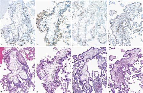 Characteristics Of Hydatidiform Moles Analysis Of A Prospective Series