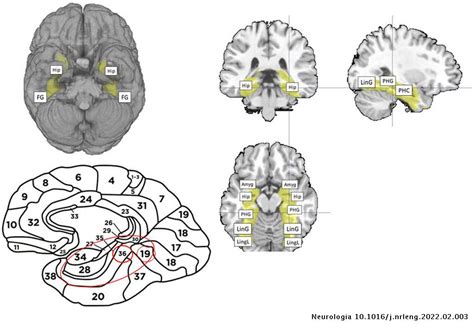 Volume Of Hippocampal Activation As A Determining Factor For The