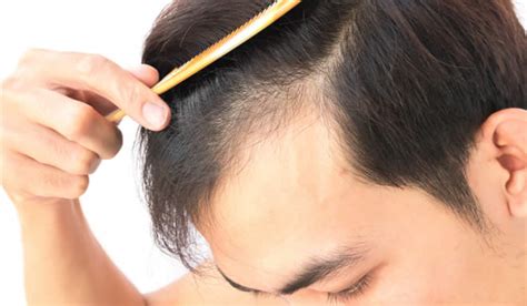 Caduta Dei Capelli Quanti Capelli Cadono Al Giorno Statistiche