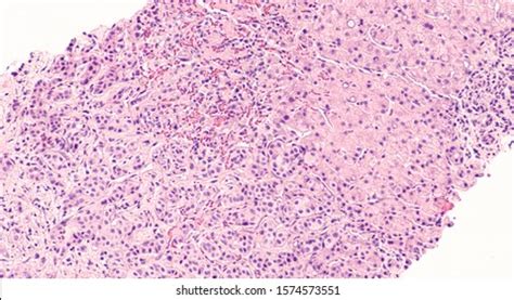 27 Bone Marrow Core Biopsy Royalty Free Images Stock Photos Pictures