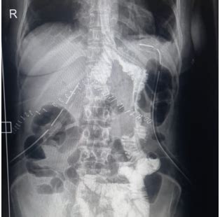 Total Gastrectomy