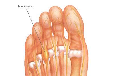 El Neuroma De Morton Causas S Ntomas Y Tratamiento