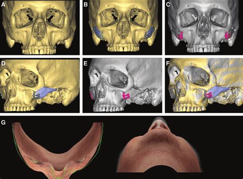 A C Zygomatic Osteotomies For Midface Feminization With Medial