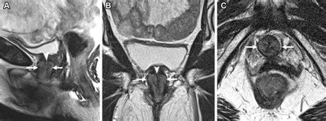 Multimodality Imaging Of Anterior Compartment Pelvic Floor Repair