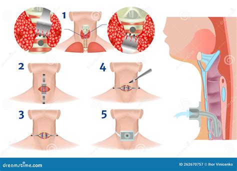 Upper And Lower Tracheostomy Tracheal Surgery Stock Vector