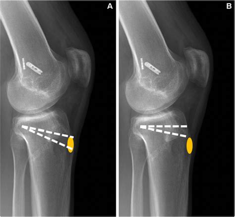 Pdf Tibial Tubercle Preserving Anterior Closing Wedge Proximal Tibial