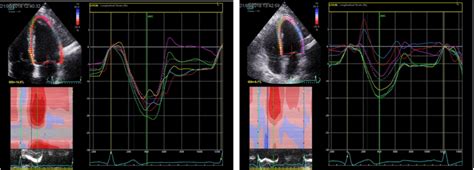 Shows 4 Chamber Recordings Of Left Ventricular Global Longitudinal Download Scientific Diagram