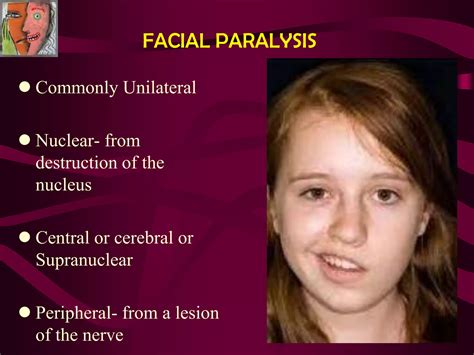 Facial Palsy Ppt