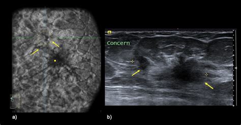 A Multifical Grade Ii Invasive Carcinoma Of No Special Type Nst With Download Scientific