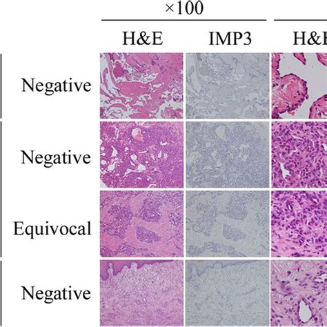 IGF2BP3 IMP3 Is Negative Or Equivocally Expressed In Pathological