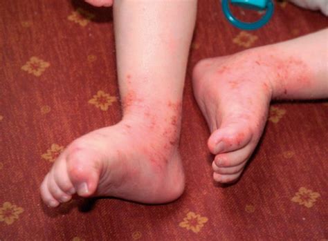 Health Concerns Atopic Eczema A Unique Child Teach Early Years