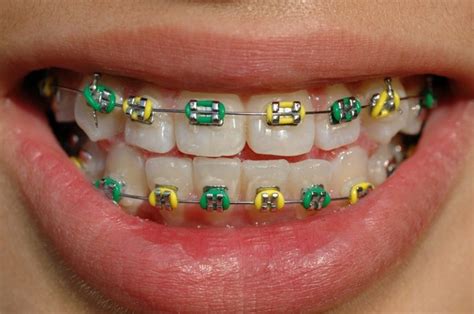 What Color Braces Should I Get Reddit – Warehouse of Ideas