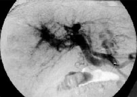 Figure From Ruptured High Flow Gastric Varices With An Intratumoral