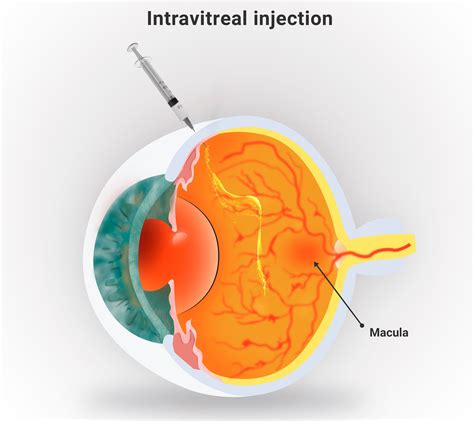 High-Dose Eylea Not Associated With Elevated IOP Risk | ASRS 2024