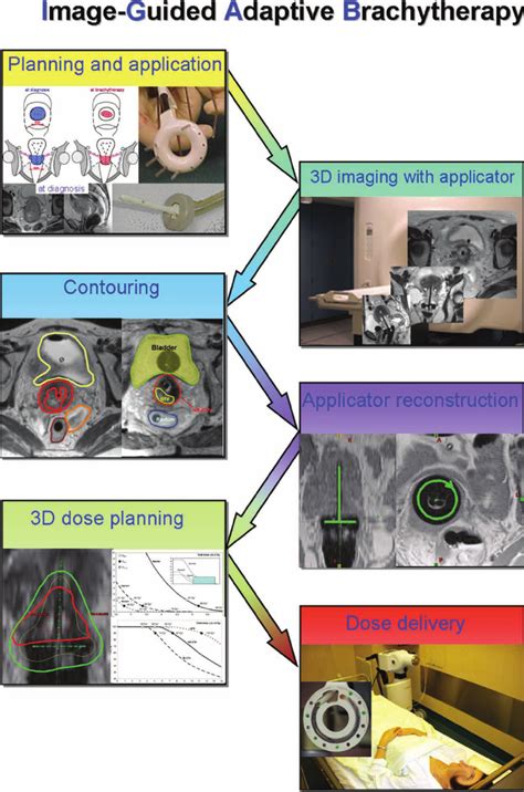 Treatment Chain For 4d Image Guided Adaptive Cervix Cancer Download Scientific Diagram