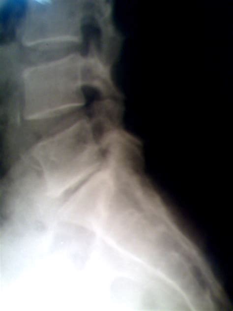 Spinal disc herniation - wikidoc