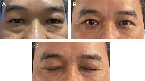 Asian Upper Blepharoplasty Clinics In Plastic Surgery