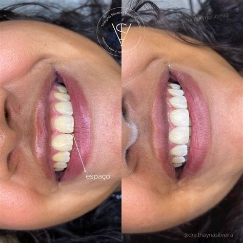 Clínica Dentista Fortaleza on Instagram Clareamento Fechamento do