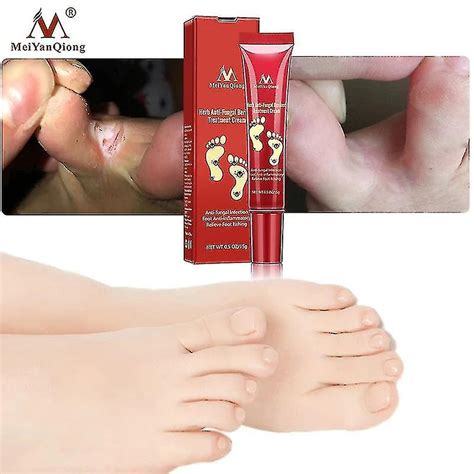 Foot Treatment Herbal Anti Fungal Infection Onychomycosis Paronychia