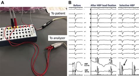 Approach To Permanent His Bundle Pacing In Challenging Implants Heart