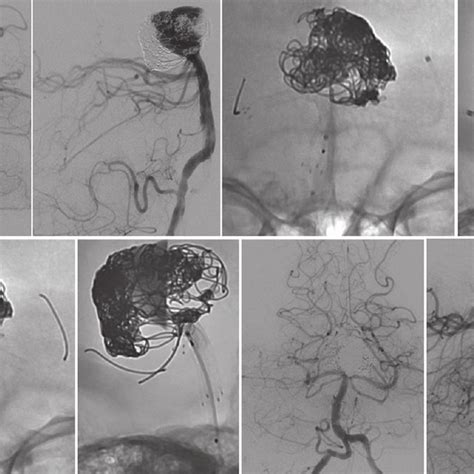 Preoperative Cerebral Angiography A Anterior Posterior And B