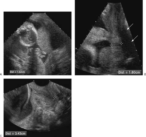 Ultrasound Evaluation Of The Cervix Radiology Key