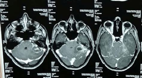 T1w Post Contrast Mri Showing Ring Enhancing Lesion In Left Cerebellar