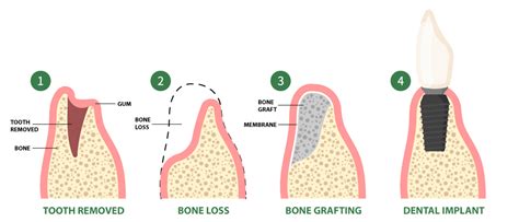 Bone Grafting Procedure Southlake Oral Surgery