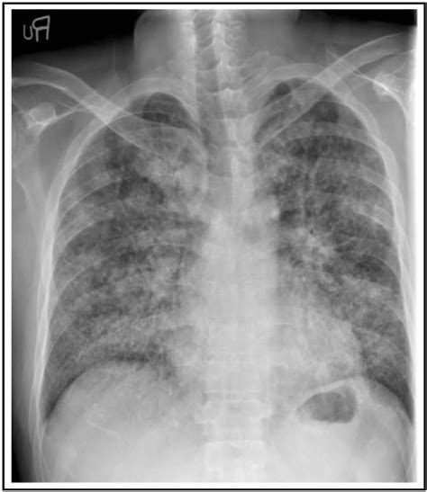 Miliary Tuberculosis Occurred After Immunosuppressive Drug In Pnh