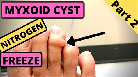 Bump On My Toe Myxoid Cyst Gets Nitrogen Freeze Part Youtube