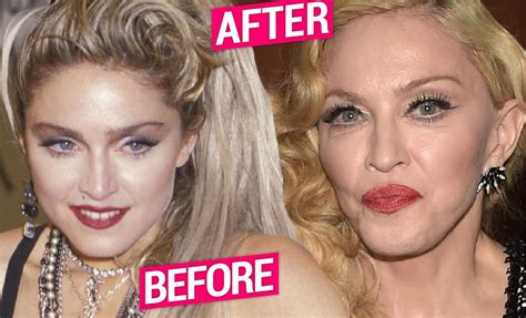 Madonna Plastic Surgery Secrets Revealed