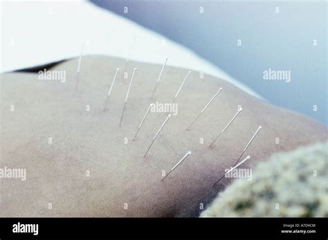 Acupuncture needles in womans back Stock Photo - Alamy