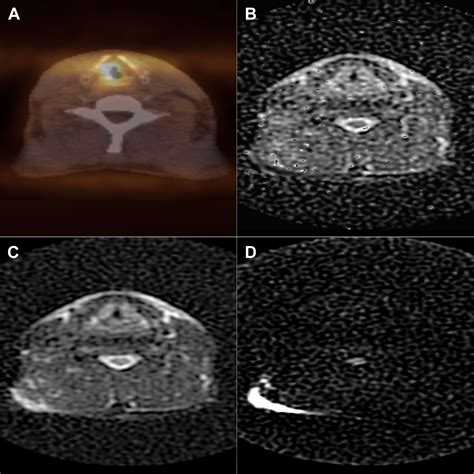 Detection Of Residual Head And Neck Squamous Cell Carcinoma After