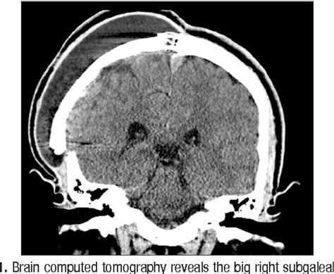 Figure 1 From Migration And Coiling Of Peritoneal Catheter Into The