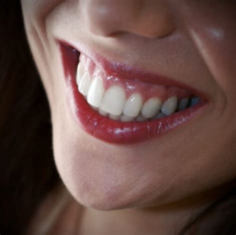 Gummy Smile Treatment John R Phelps Dds