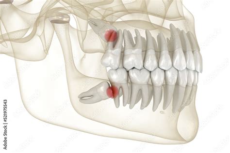 Mesial Impaction Of Wisdom Teeth To The Second Molar Medically